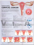 Understanding Cervical Cancer Anatomical Chart